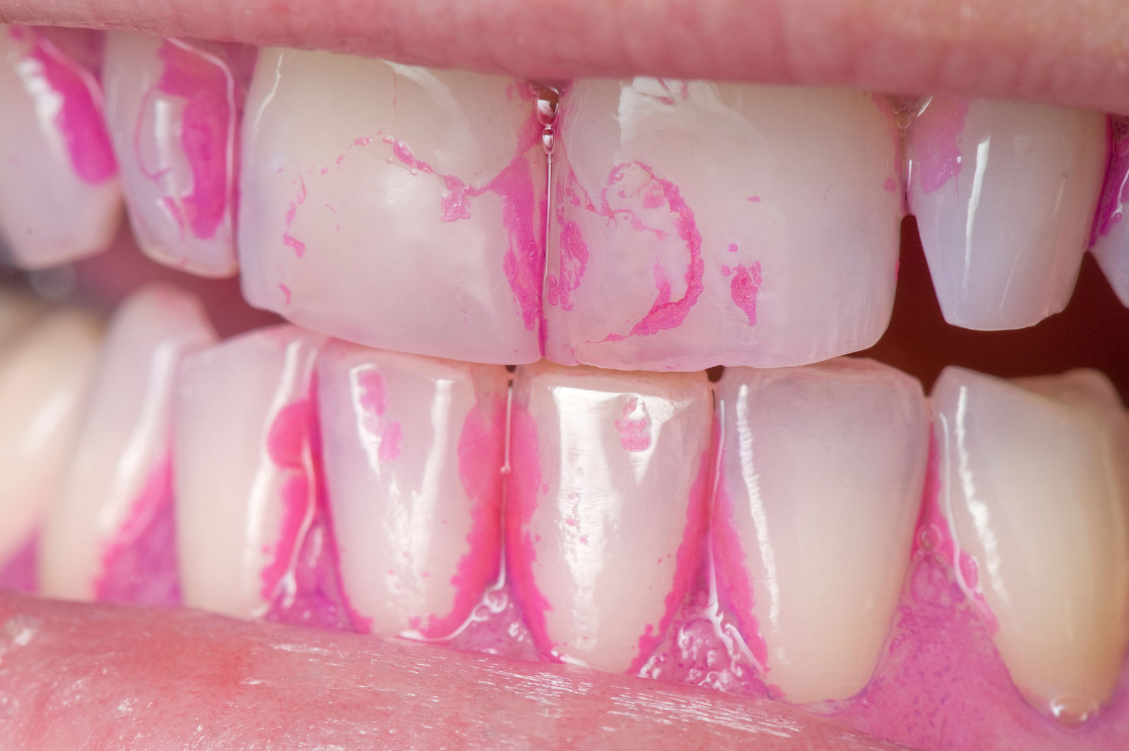 fucorcine sur les dents