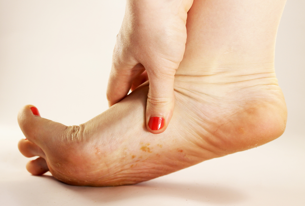 de oorzaak van de geur in schoenen is voetschimmel